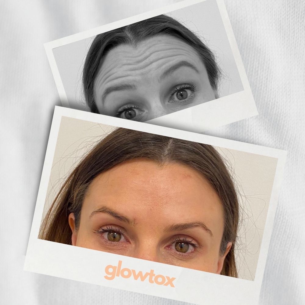 Ergebnis Foto Stirnfalte braunhaarige Frau glowtox