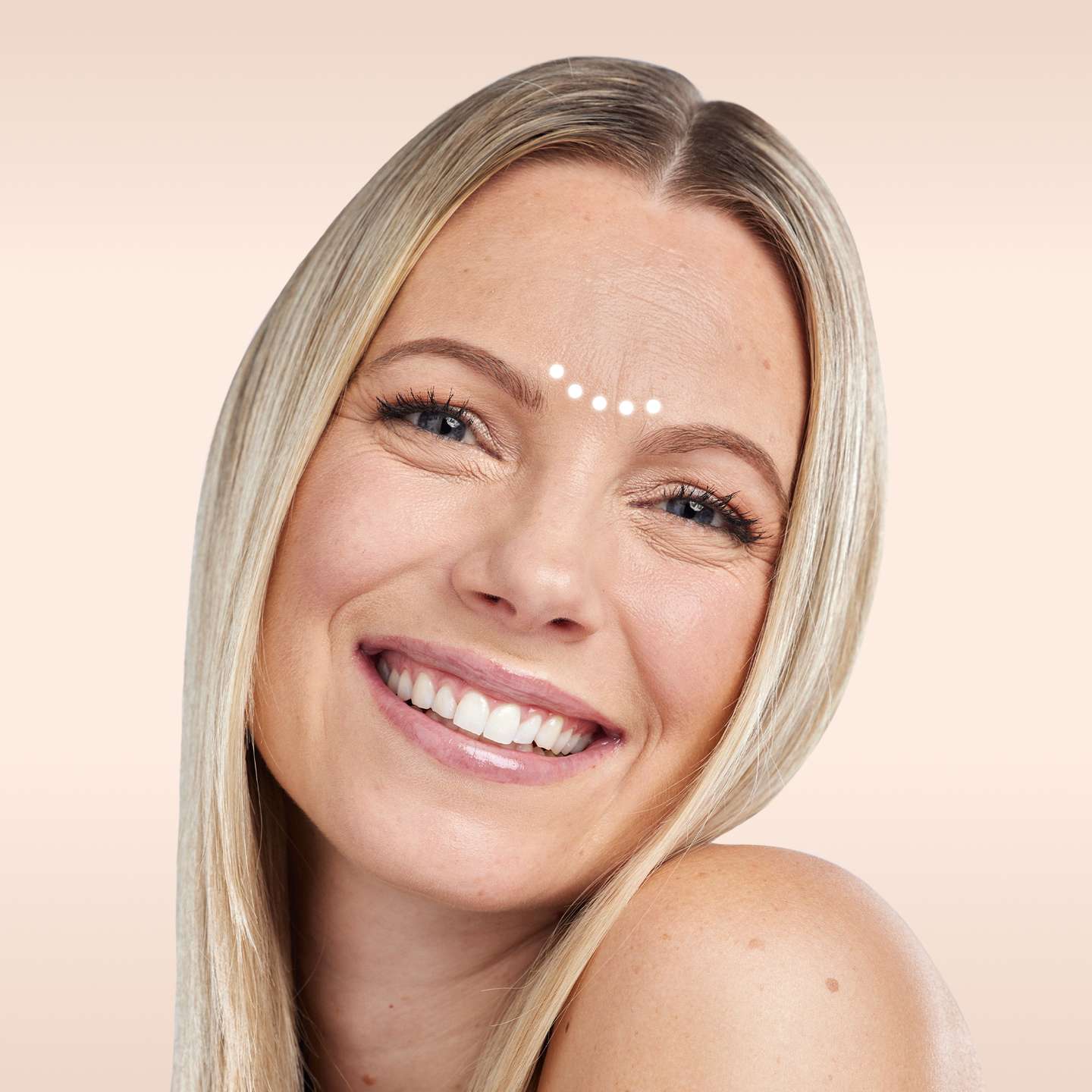 Bild eines Modells Zornesfalte Behandlung glowtox